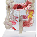 Colon Budget Model