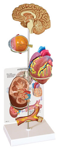 Hypertension Model Set Budget Range