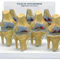 4-Stage Osteoarthritis Knee - Budget Model