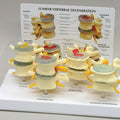 Four Stage Vertebrae - Budget Model