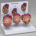 3-Mini Heart Set - Budget Model