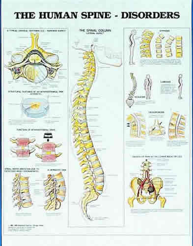 Human Spine Disorders Chart