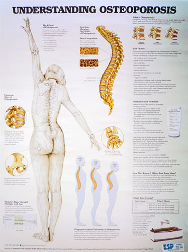 Understanding Osteoporosis Chart
