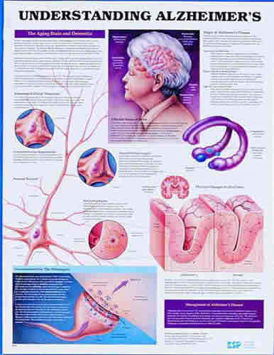 Understand Alzheimers Chart