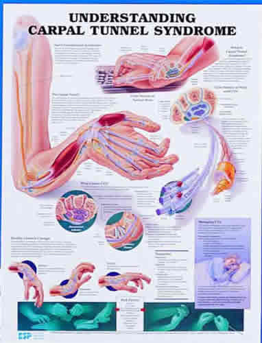 Understand Carpal Tunnel Chart
