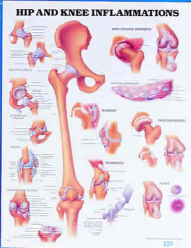 Hip & Knee Inflammation Chart.