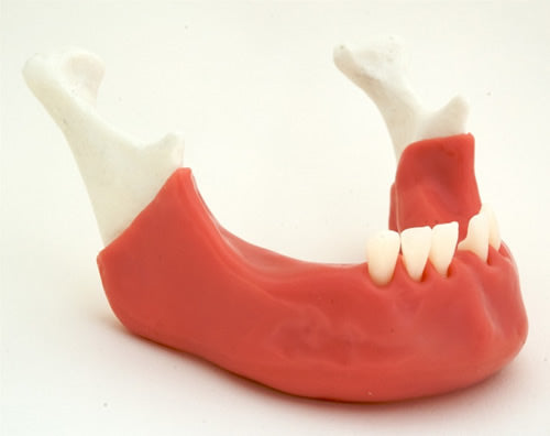Partially Endentulous Mandible with Tissue