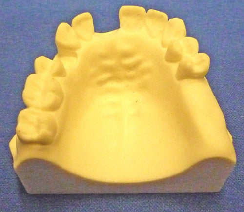 Partially Endentulous Maxilla
