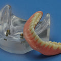 Dental Implant Overdenture Model with Two Locator Inserts