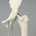 Hip Joint with Resurfacing Implant