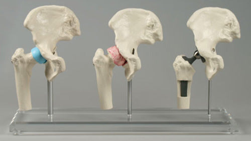 Hip Implant Model - Set of 3 Joints
