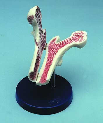 Femur Head With Osteoporosis