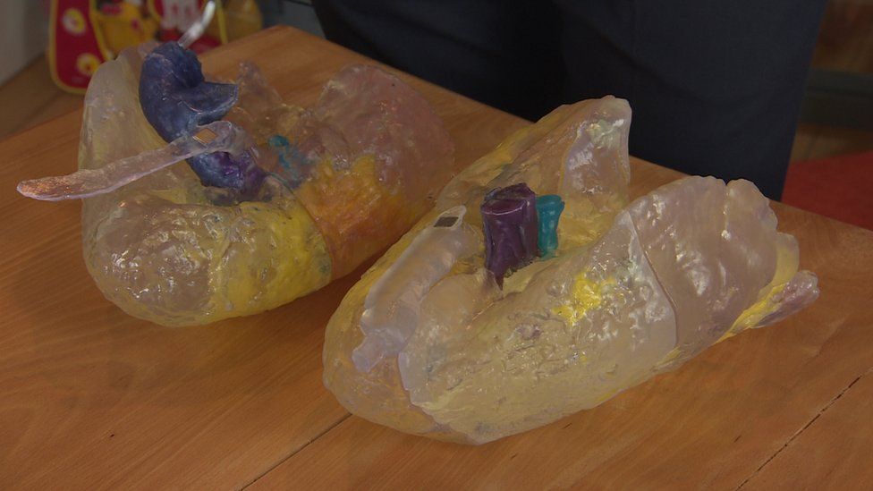 3D Printed COVID-19 Lungs Full Size