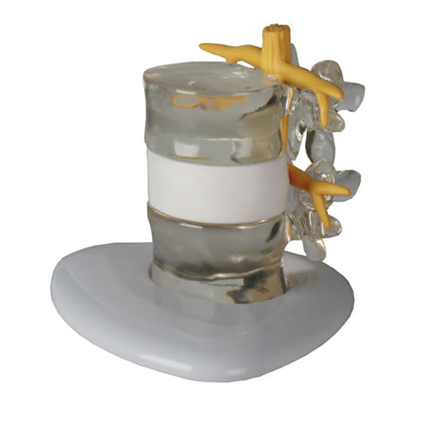 Vertebral Disc Prolapse Simulator