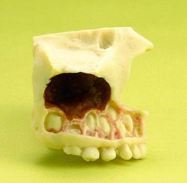 Teeth Eruption