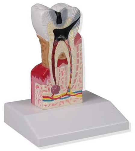 Dental Caries Model, 10x Life Size