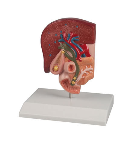 Gallstone Model