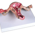 Uterus Model with Diseases