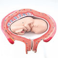 Uterus, 5th Month, Breech